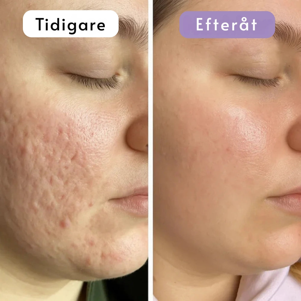 DermaSilk | Slätare hud & mindre synliga ärr