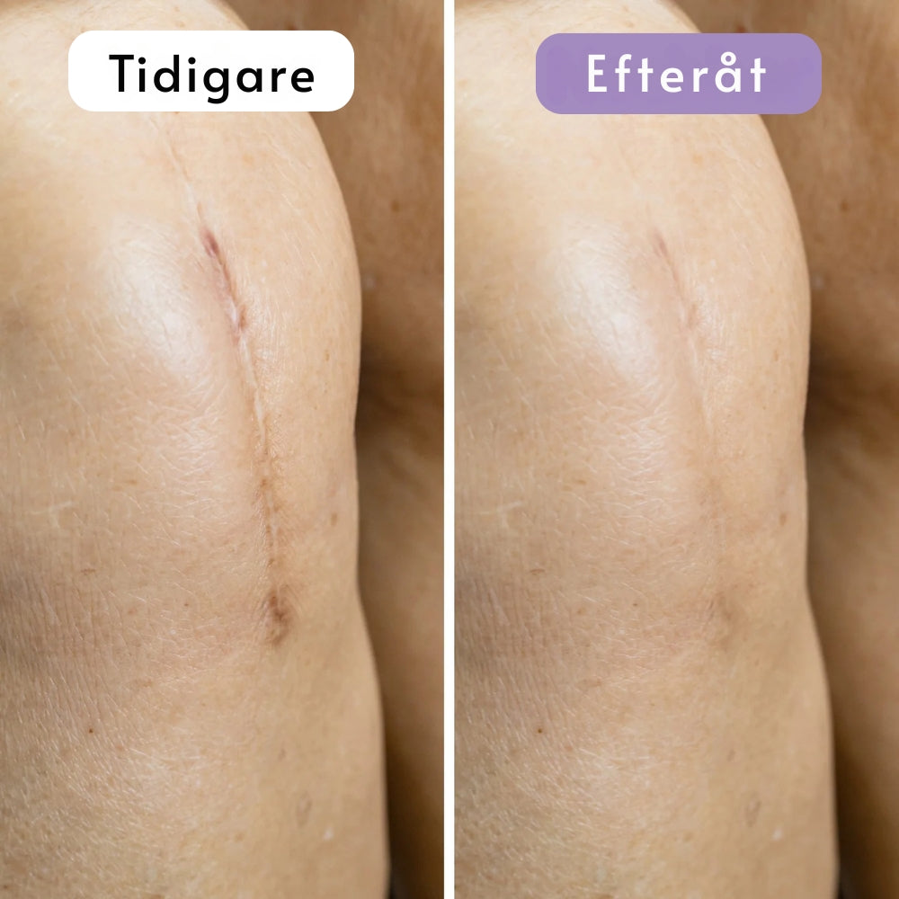 DermaSilk | Slätare hud & mindre synliga ärr