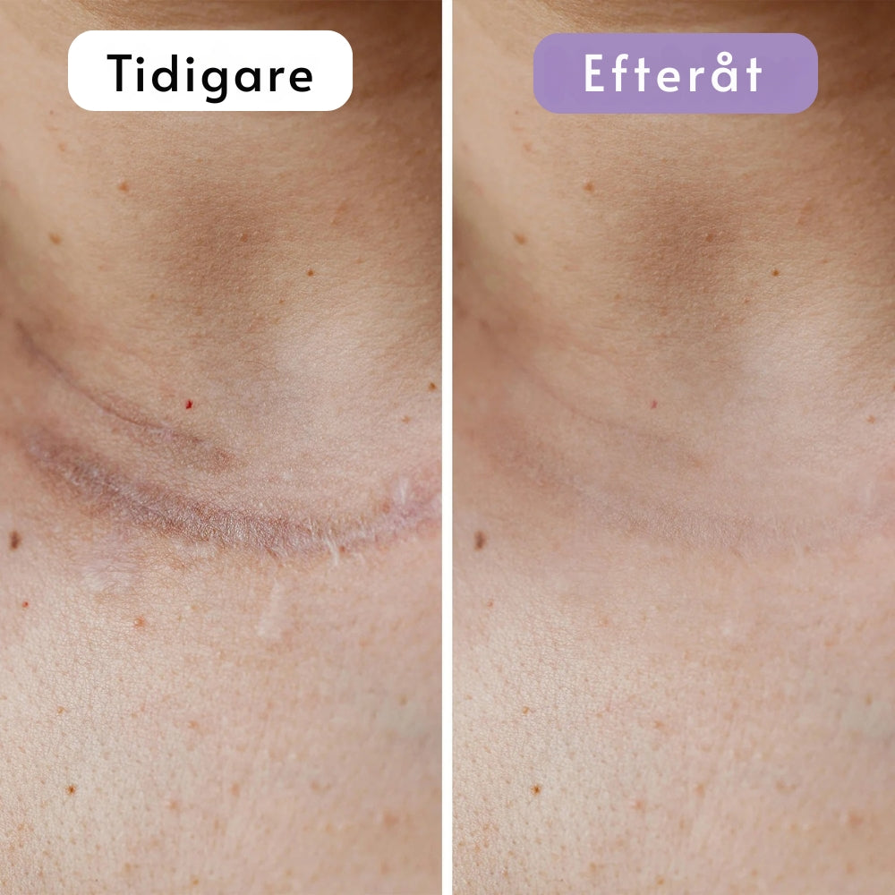 DermaSilk | Slätare hud & mindre synliga ärr